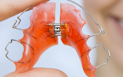 Palatal Expanders 