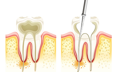 Root canal diagram