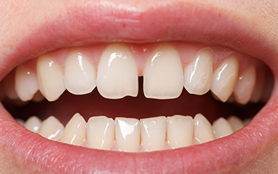 Diastema