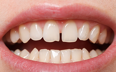 Diastema between upper incisors