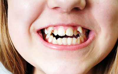 How Pediatric Dentists Identify Bite Issues Early
