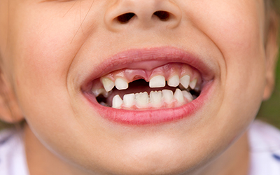 What Causes Teeth to Shift During Childhood and Adolescence